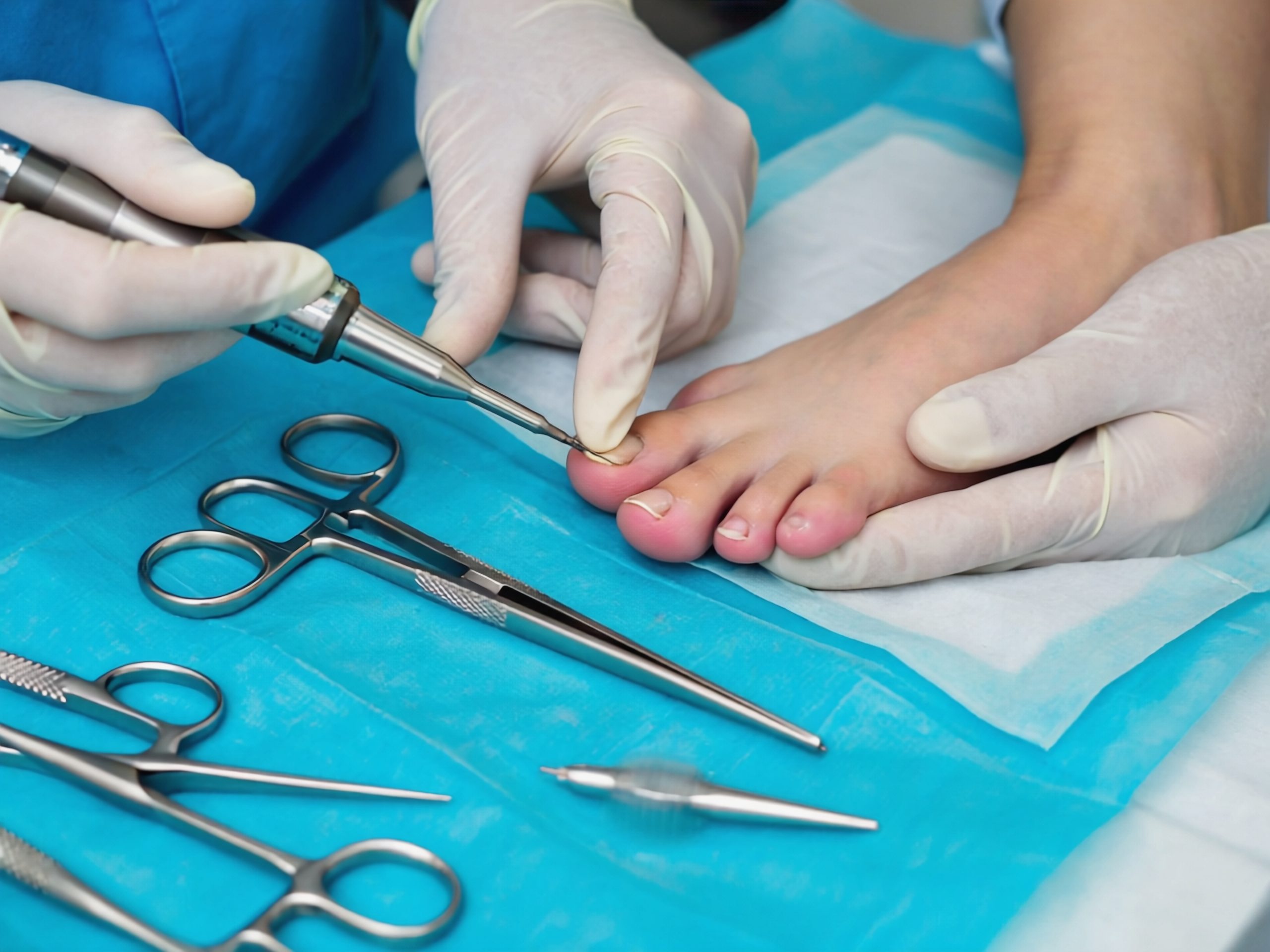 Nail Fenestration Lacuna Method